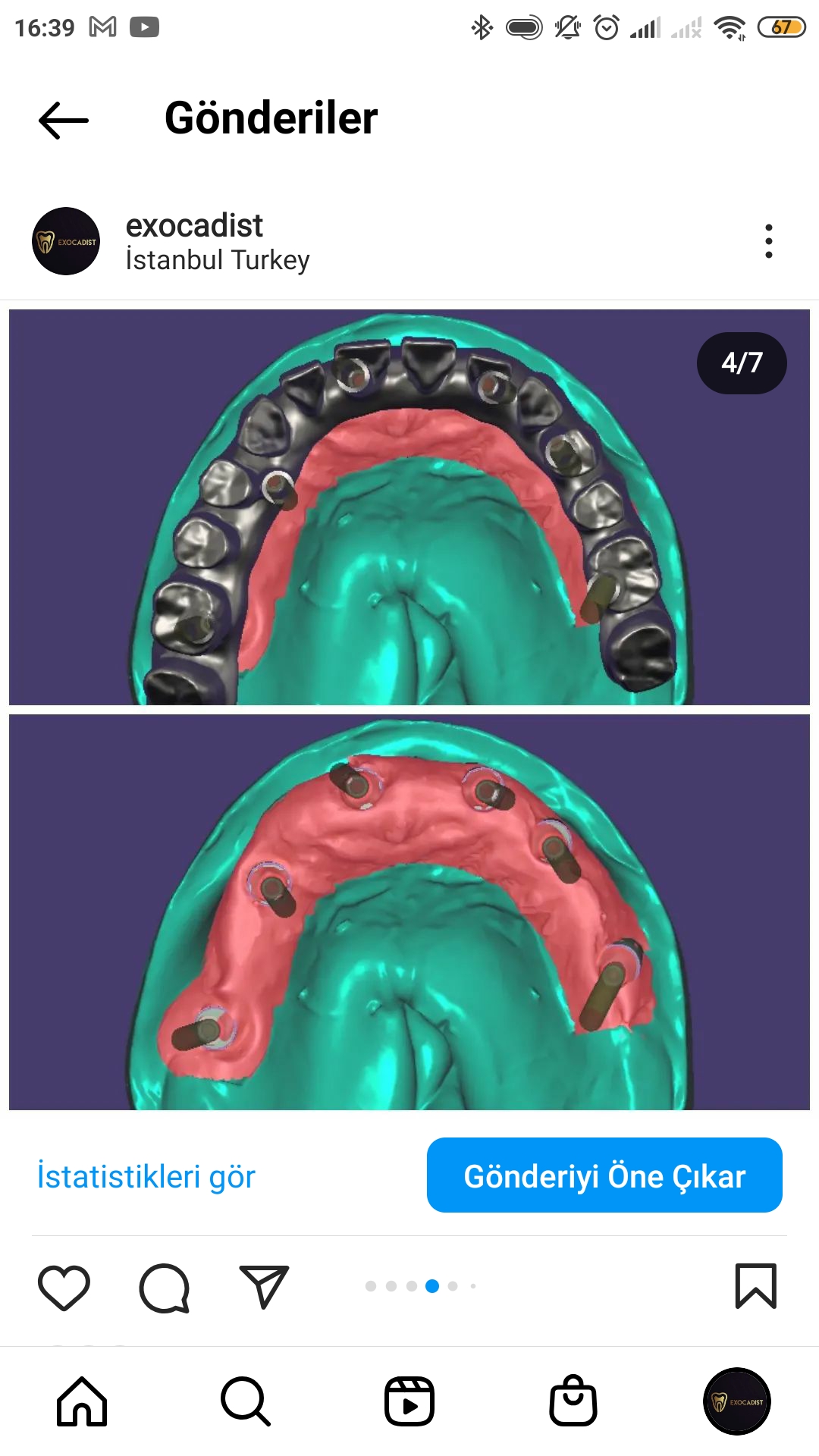 Occlusal Screw Crown