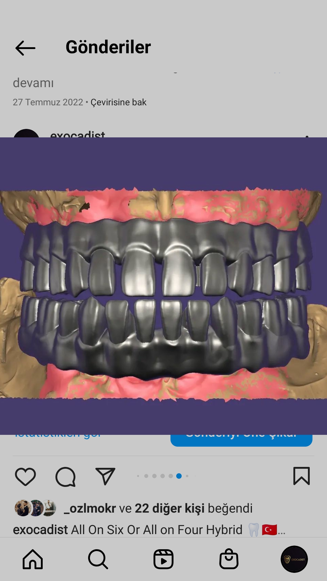 Occlusal Screw Crown