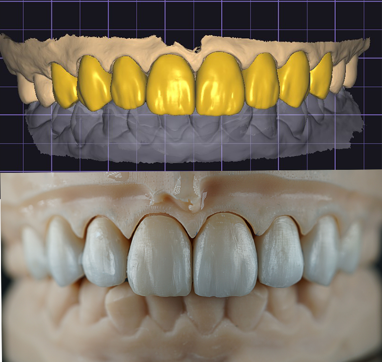 Full Contour Zirconia