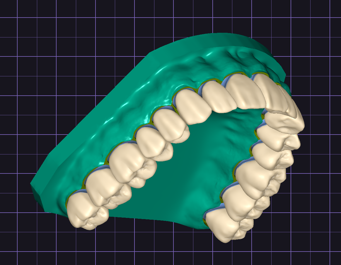 Anatomic Crown And Bridge