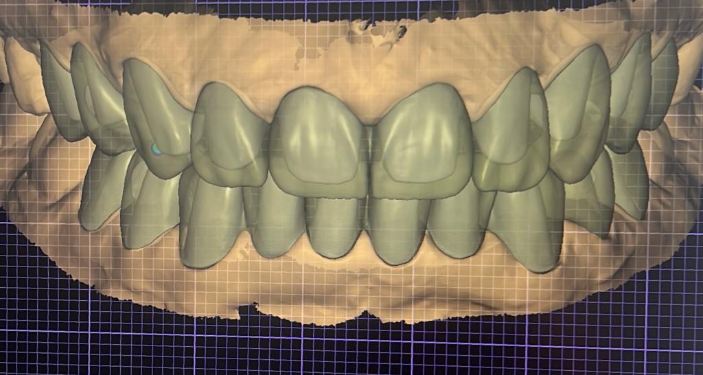 Smile Design - Lithium Disilicate - Monolithic Zirconia - Temporary Crown - Titanium Bar Design