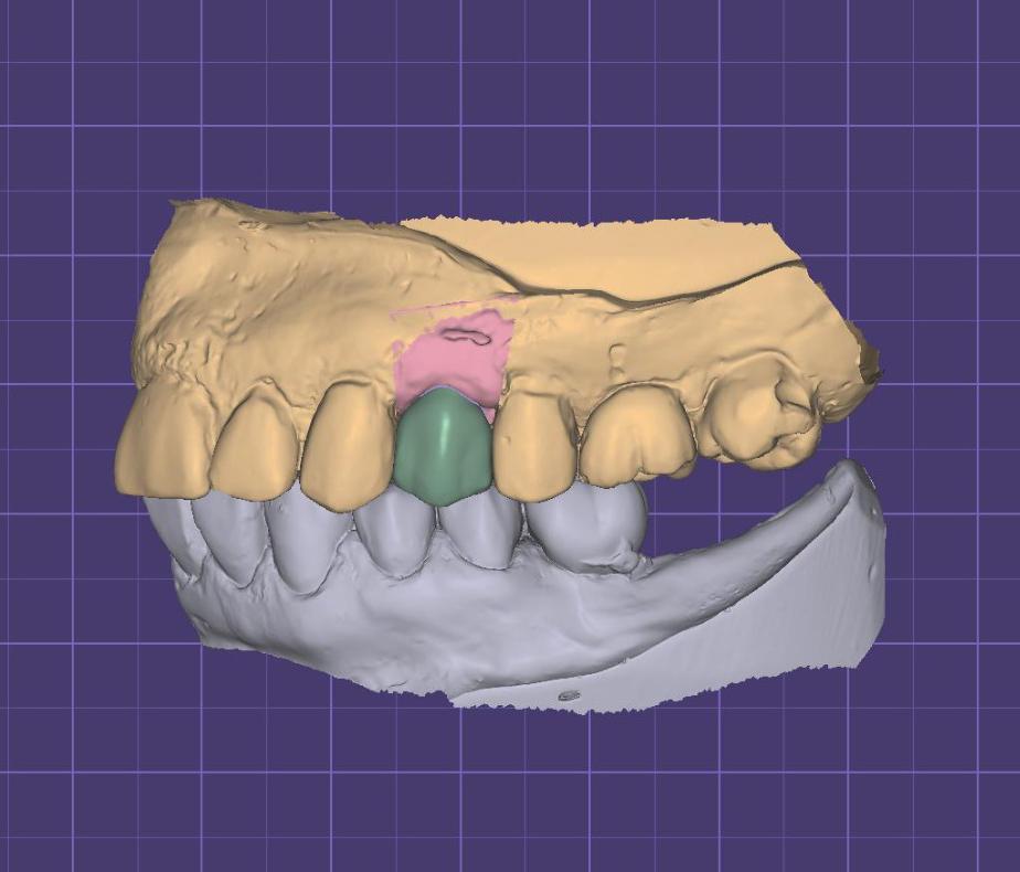 Outsource Crown and Bridge Design Services.