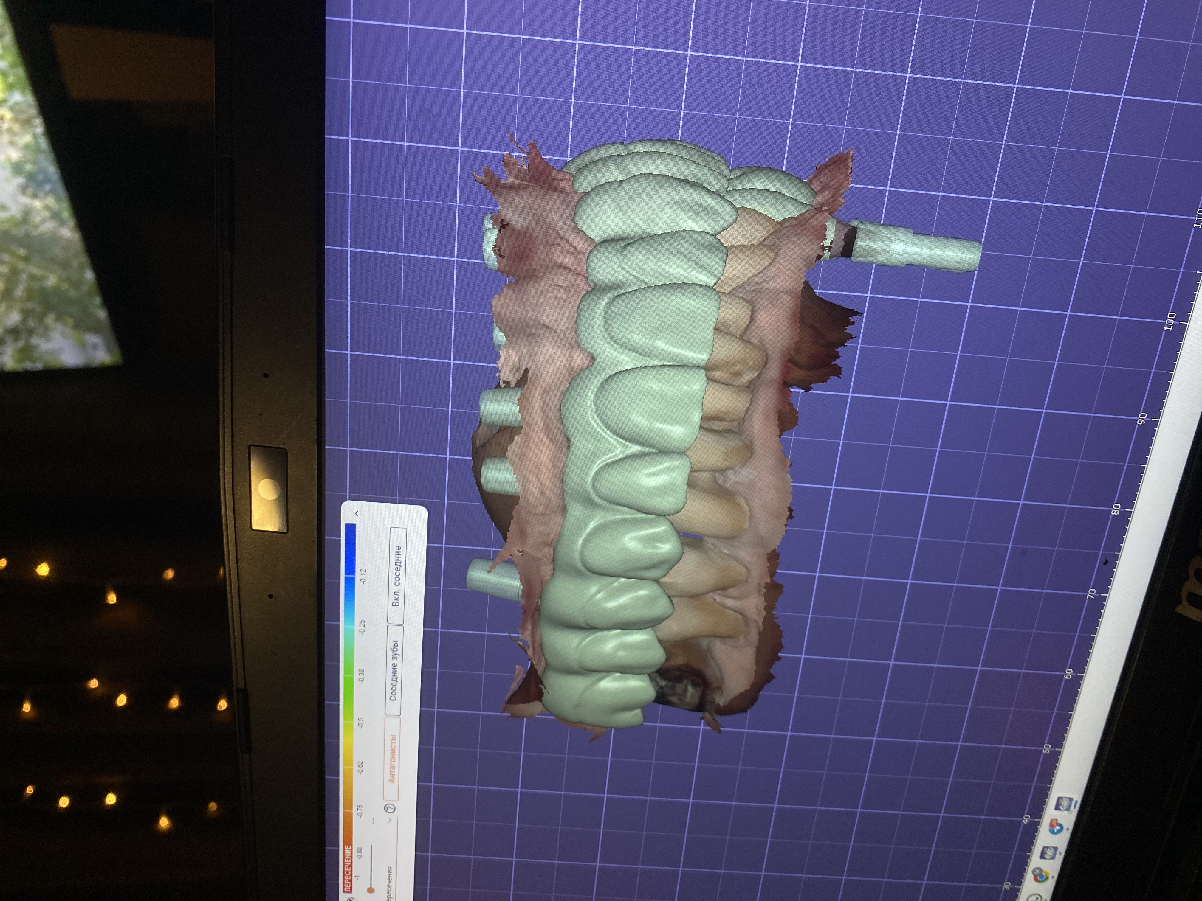 Dental CAD Design – Crowns, Bridges & Implant Cases (exocad)