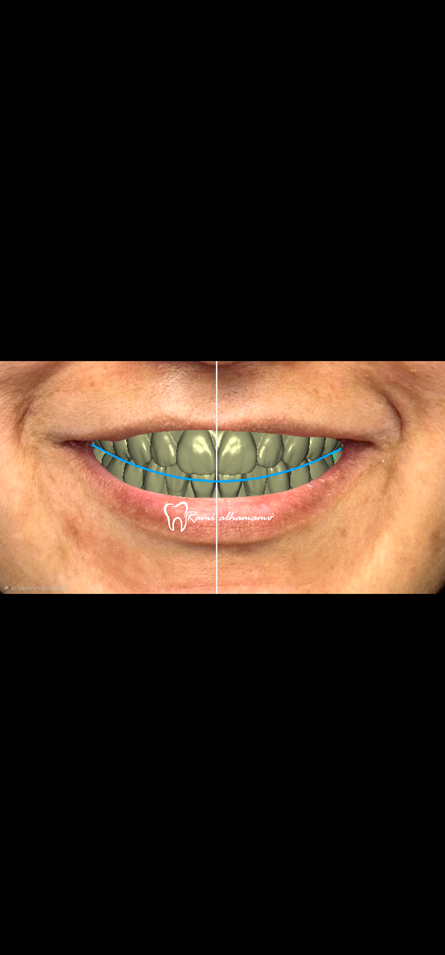 AOX all on x Hybrid Denture