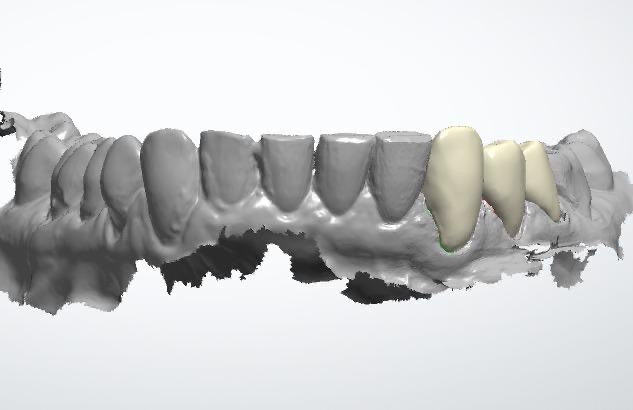 3Shape Dental CAD Design | Crown & Bridge