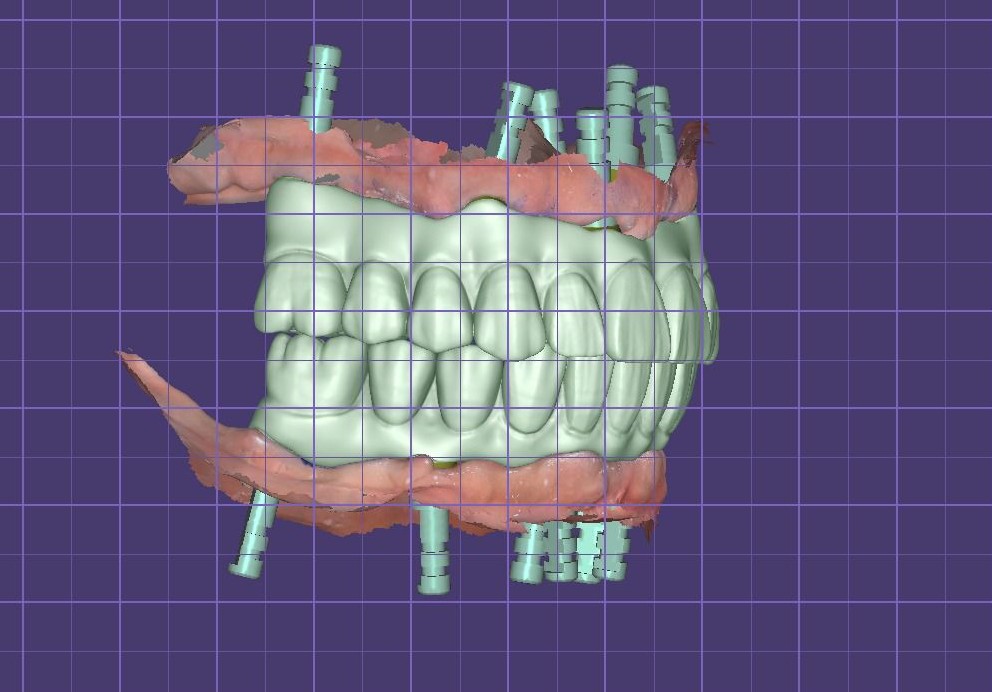 implant üstü full tasarım