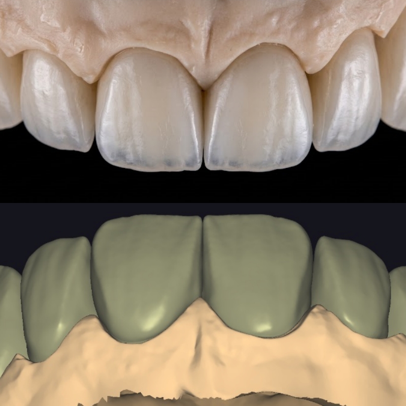 High-End Aesthetic Veneer Design | Digital Smile Design (DSD)