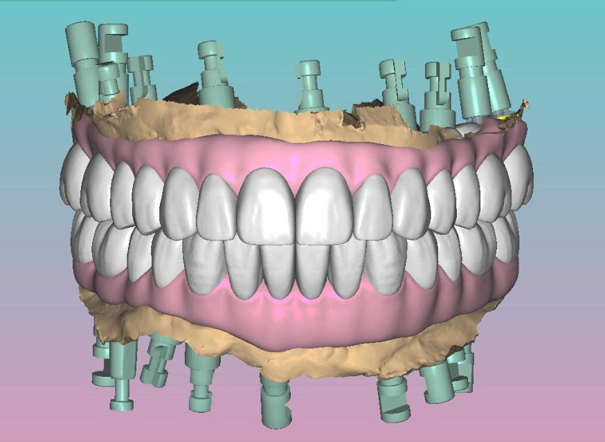 Full arch Zirconia Design
