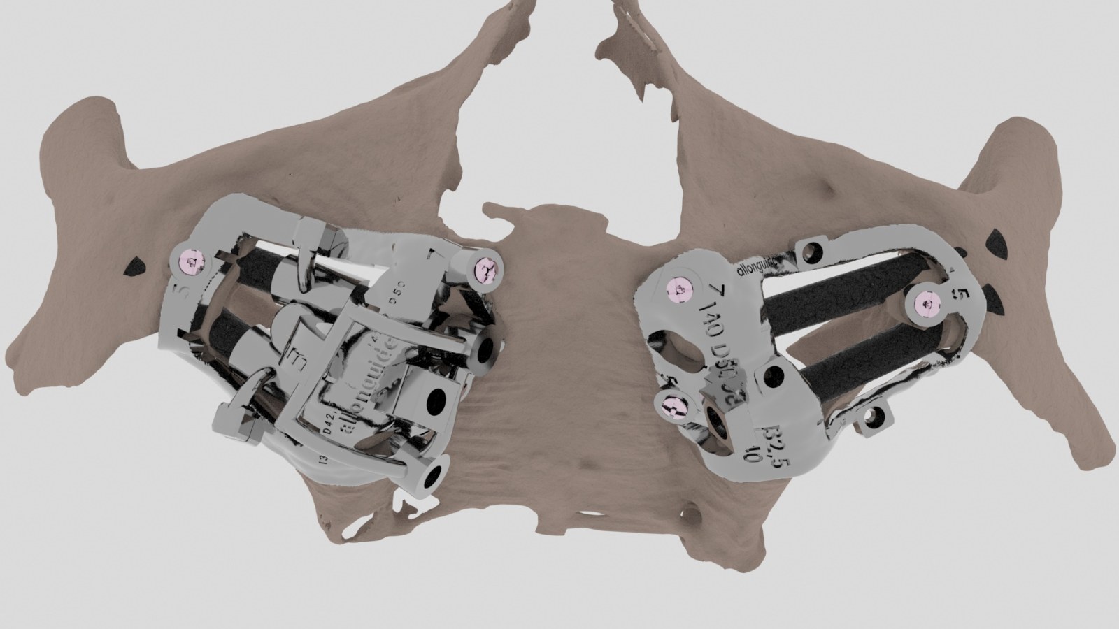 Zigoma Guide: Patented Stackable Surgical Guide for Zygomatic Implants