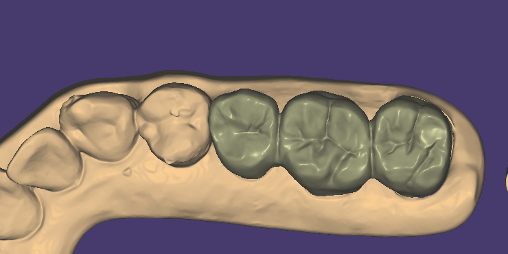 Dental CAD Design: Crowns, Bridges, Veneers, Inlays & Surgical Guides planning